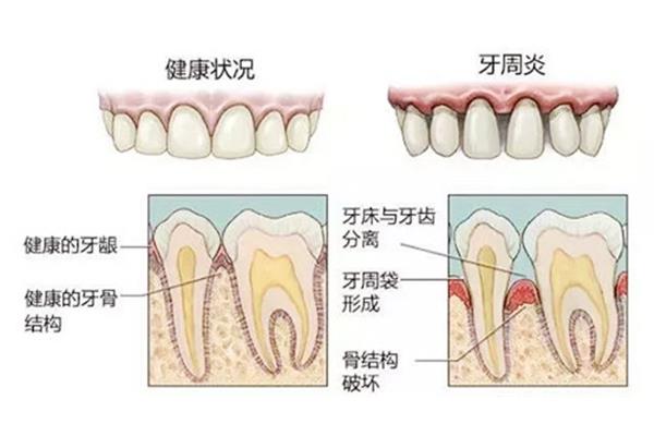 牙龈一碰就出血