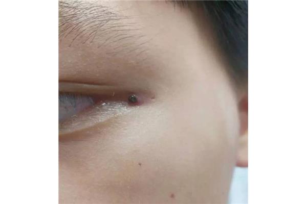 蜱虫怎么预防