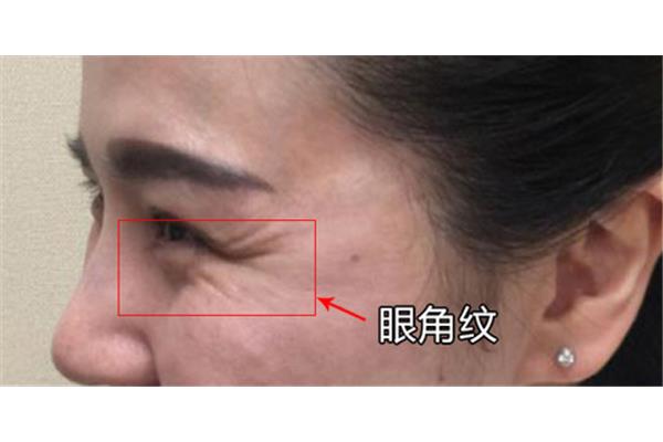 眼角鱼尾纹