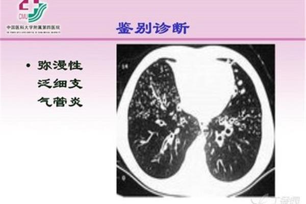 支气管炎鉴别诊断