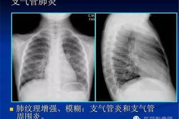 支气管炎鉴别诊断