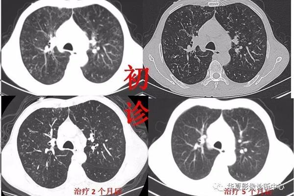 支气管炎鉴别诊断