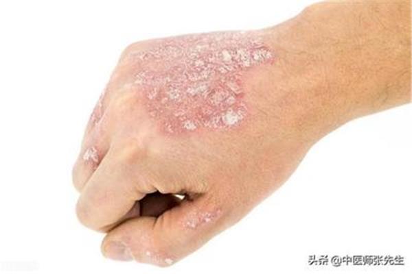 燥热的症状