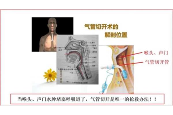 喉头水肿家庭自救