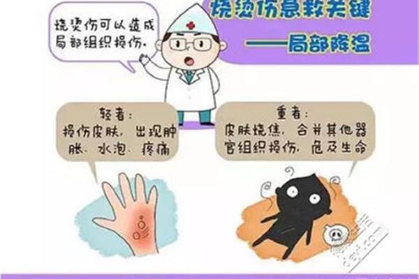 烫伤的处理方法