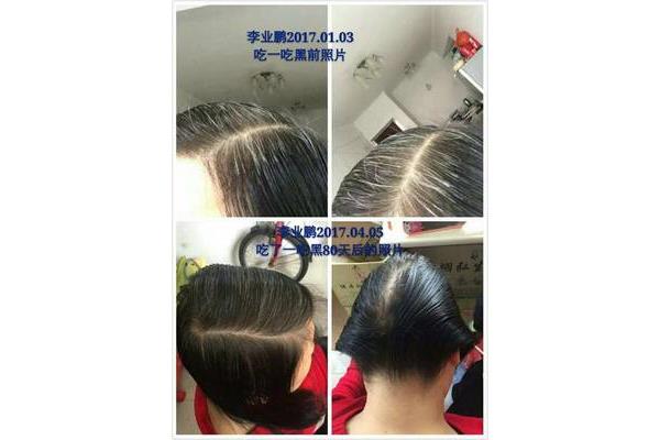 白发怎么变黑发