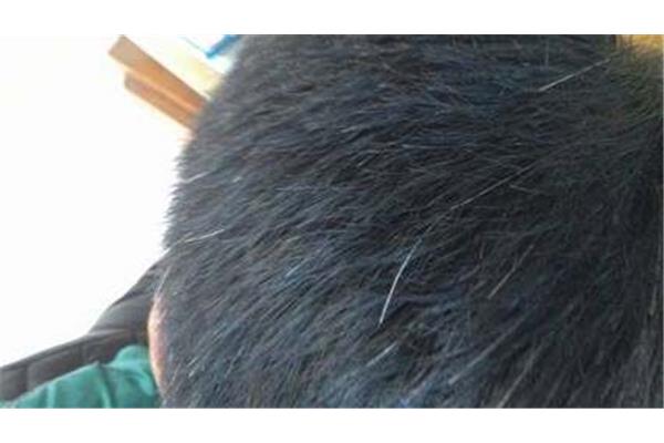 白发怎么变黑发