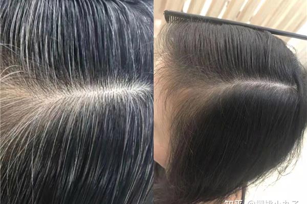 白发怎么变黑发