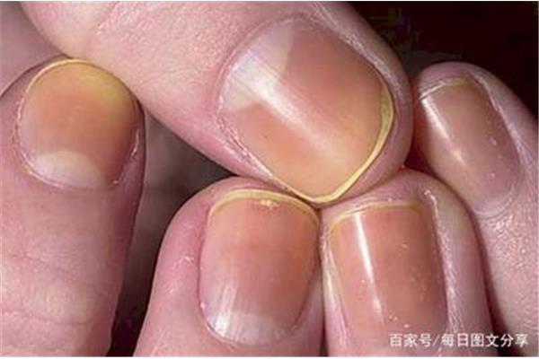 hiv早期症状