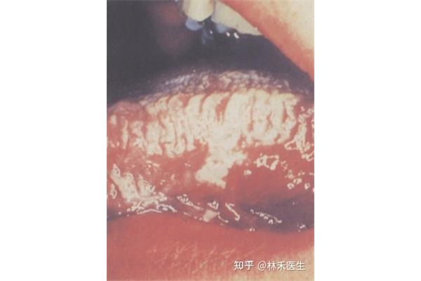 hiv早期症状