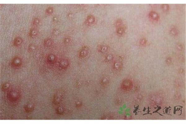 hiv早期症状