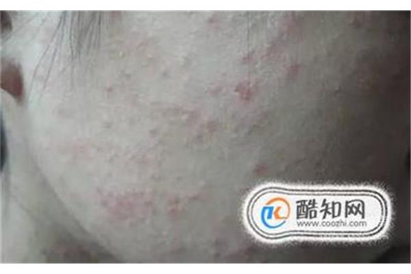 hiv早期症状