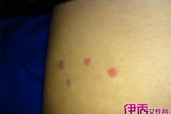 hiv早期症状