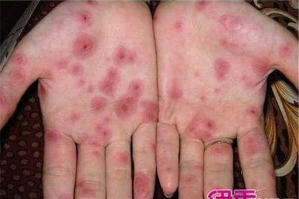 hiv早期症状