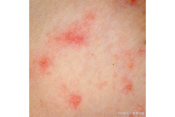 hiv早期症状