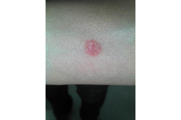 hiv早期症状