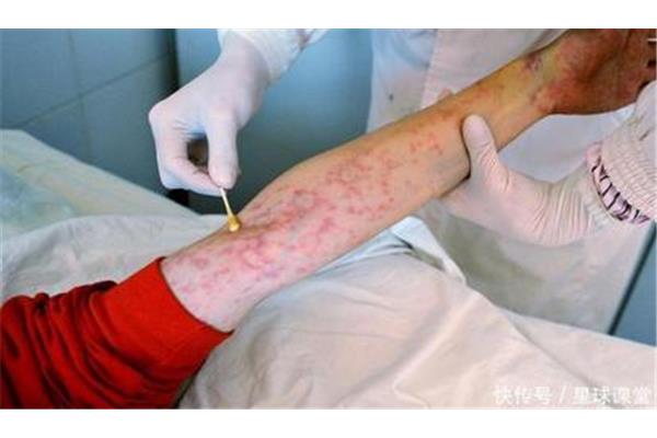 hiv早期症状