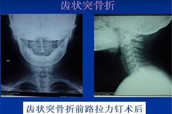 枢椎齿状突骨折