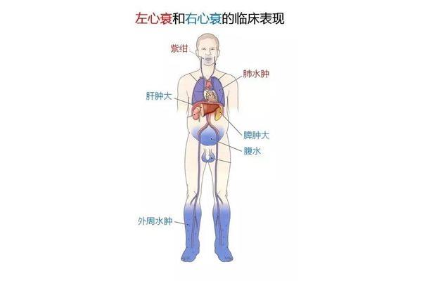 左心衰的临床表现