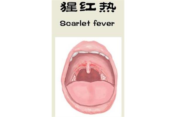 咽峡炎链球菌