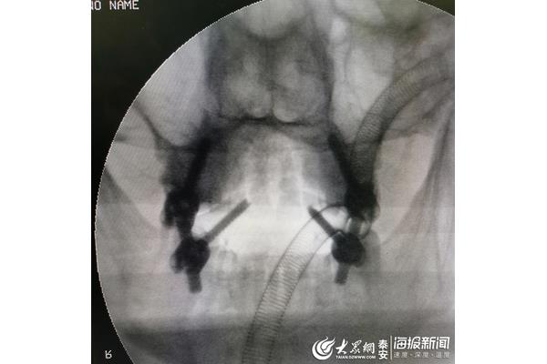 枢椎齿状突骨折