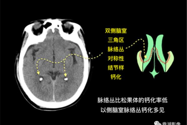 松果体钙化