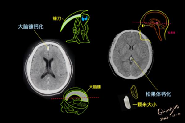 松果体钙化