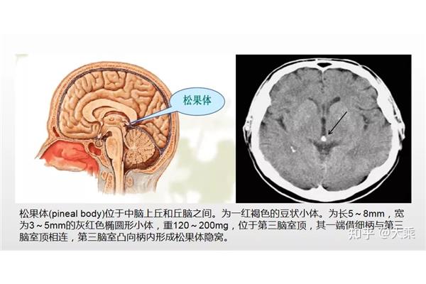 松果体钙化