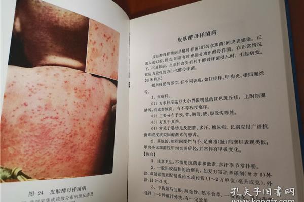 酵母菌感染