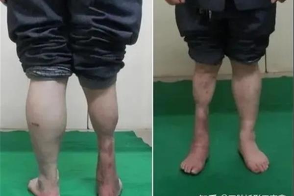 足内翻怎么矫正