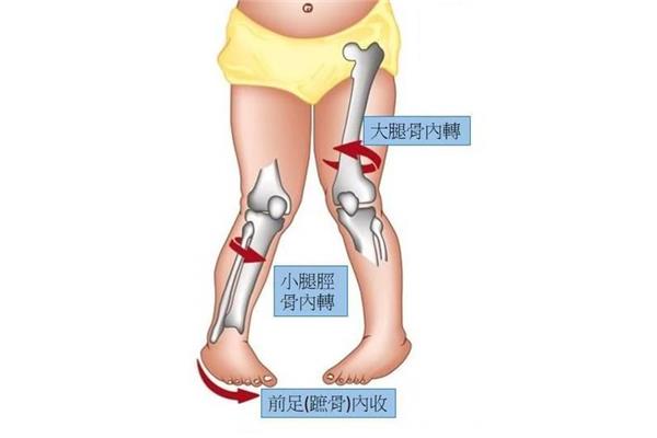 足内翻怎么矫正