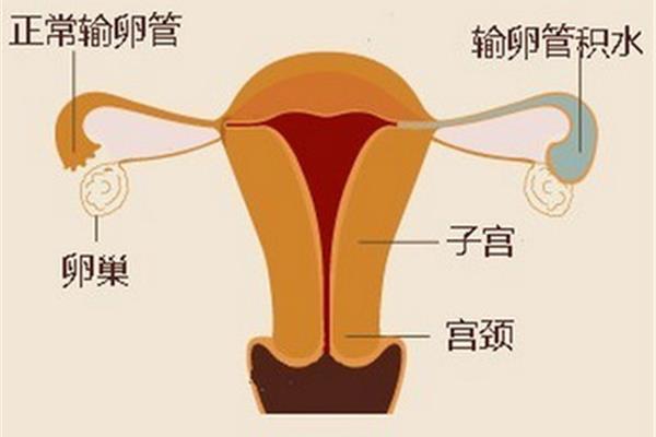盆腔积液多少正常
