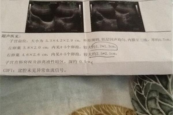 盆腔积液多少正常