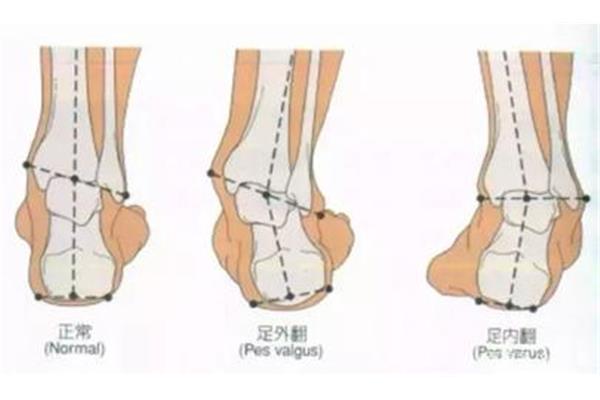 足内翻怎么矫正