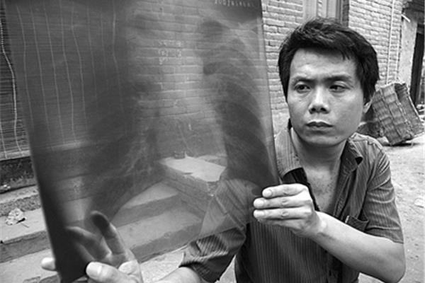 开胸验肺事件