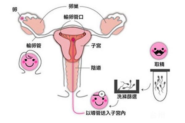 人工受孕流程