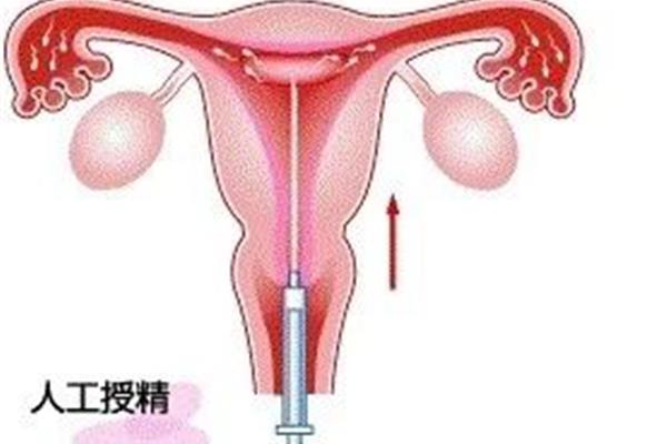 人工受孕流程