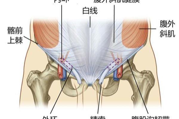 斜疝和直疝的区别