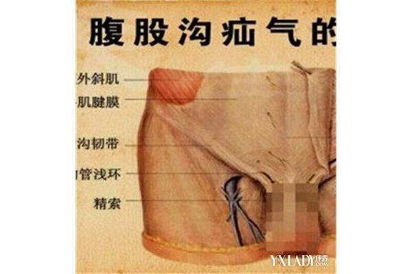 斜疝和直疝的区别