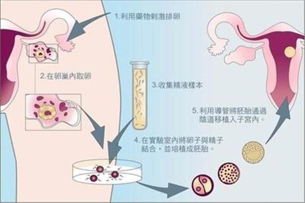 人工受孕流程