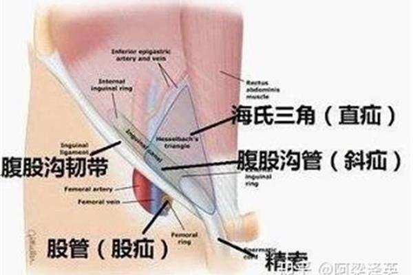 斜疝和直疝的区别