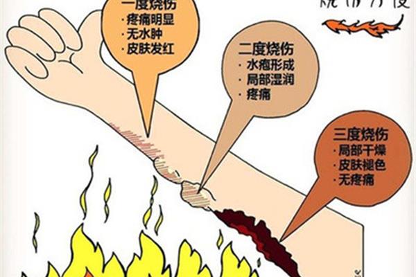烧伤后怎么办