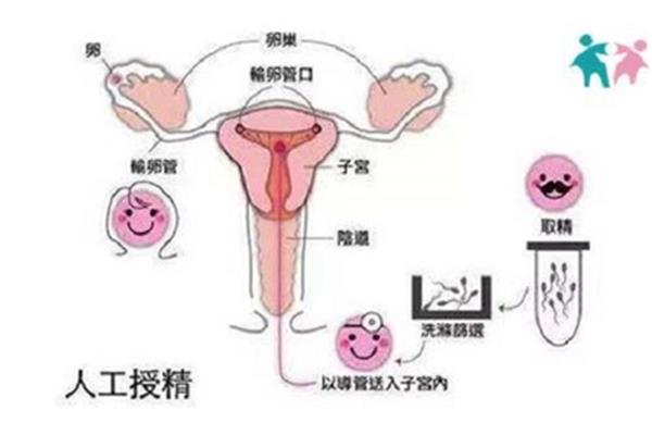 人工受孕流程