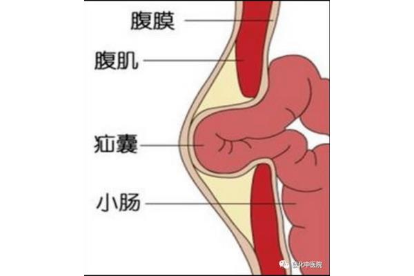 斜疝和直疝的区别