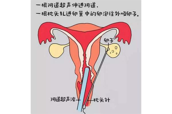 人工受孕流程