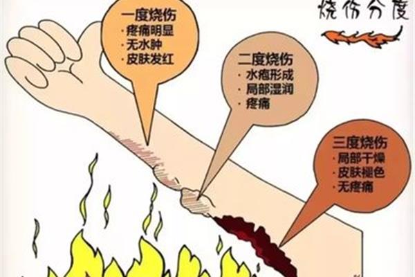 烧伤后怎么办