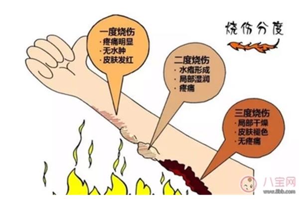 烧伤后怎么办