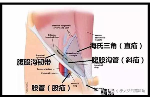 斜疝和直疝的区别