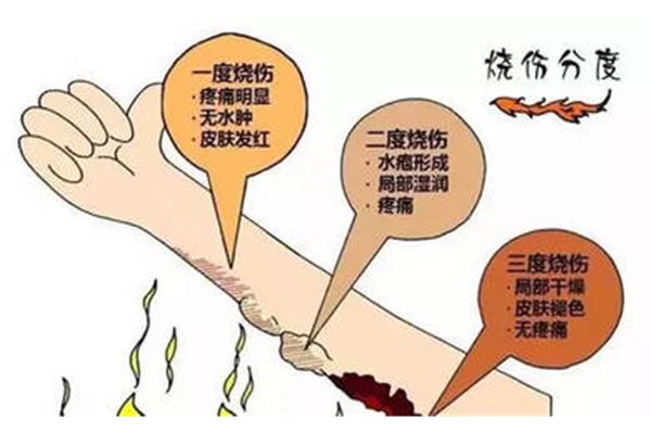 烧伤后怎么办