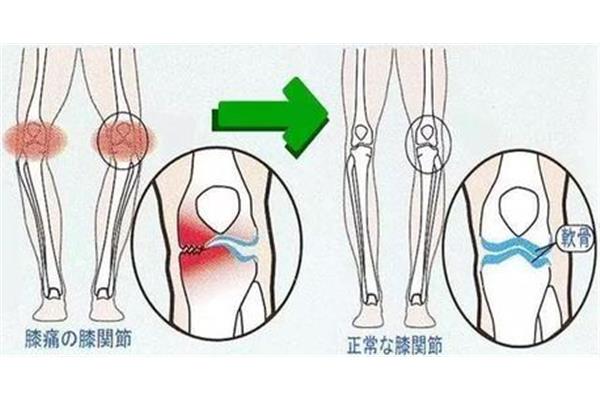膝盖肿痛什么原因